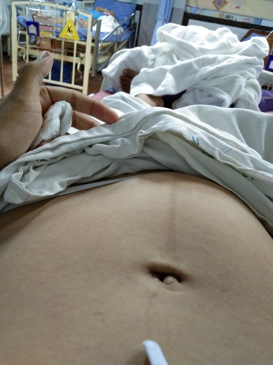 คลอดก่อนกำหนด