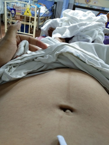 คลอดก่อนกำหนด