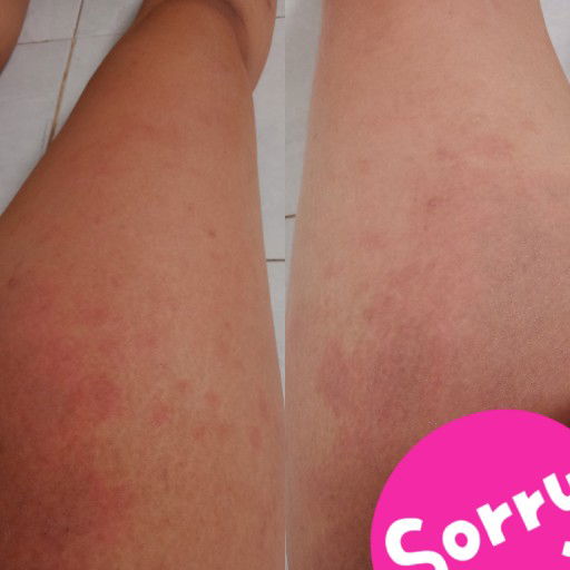 cara mengatasi gatal" saat hamil