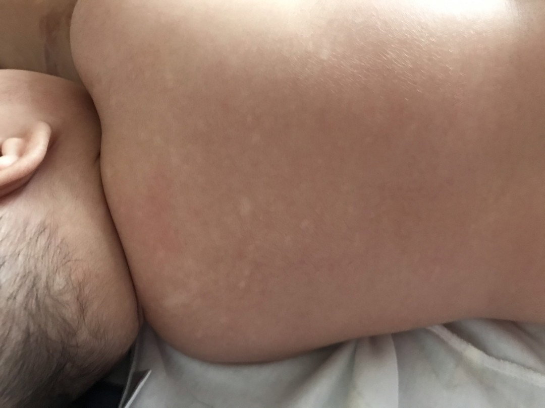 Đốm trắng trên da ở lưng