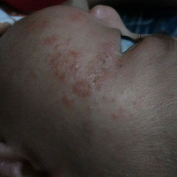 Merah2 Di Wajah Bayi