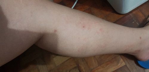 skin allergy 7months preggy