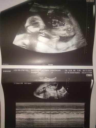 4months ultrasound