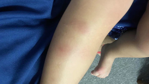 Rashes