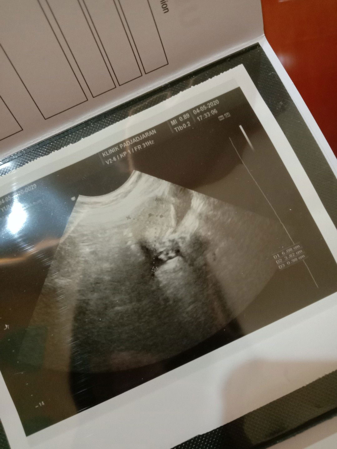 penebalan dinding rahim itu hamil ga sih bun?