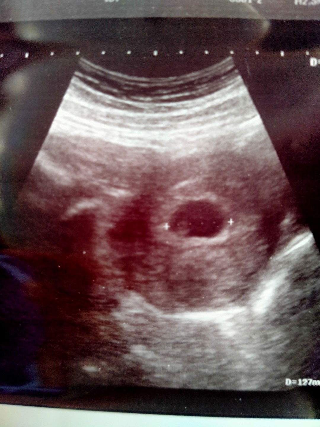 กังวลอาการแพ้ท้องหาย