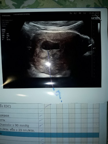 หมอบอกท้องลม!! 50/50