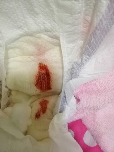 Bleeding