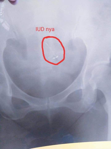 HATI HATI BAGI BUNDA YANG MAU PASANG KB IUD. Repost dari temen.. hanya sekedar sharing
