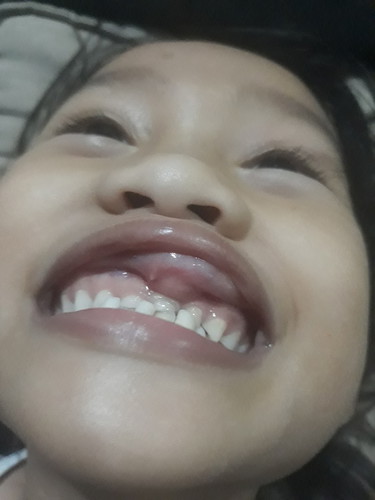 pamamaga sa ilalim ng labi