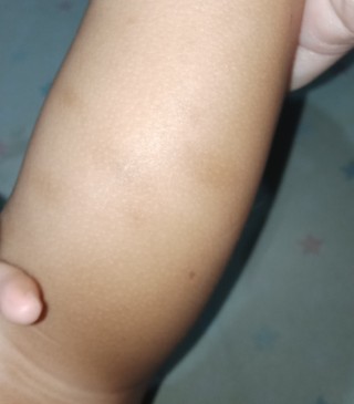 Dark spot sa binti