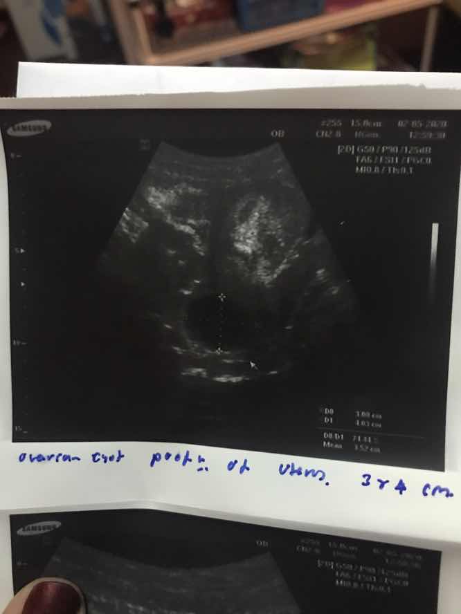 ถุงน้ำหลังรังไข่อันตรายไหมคะ