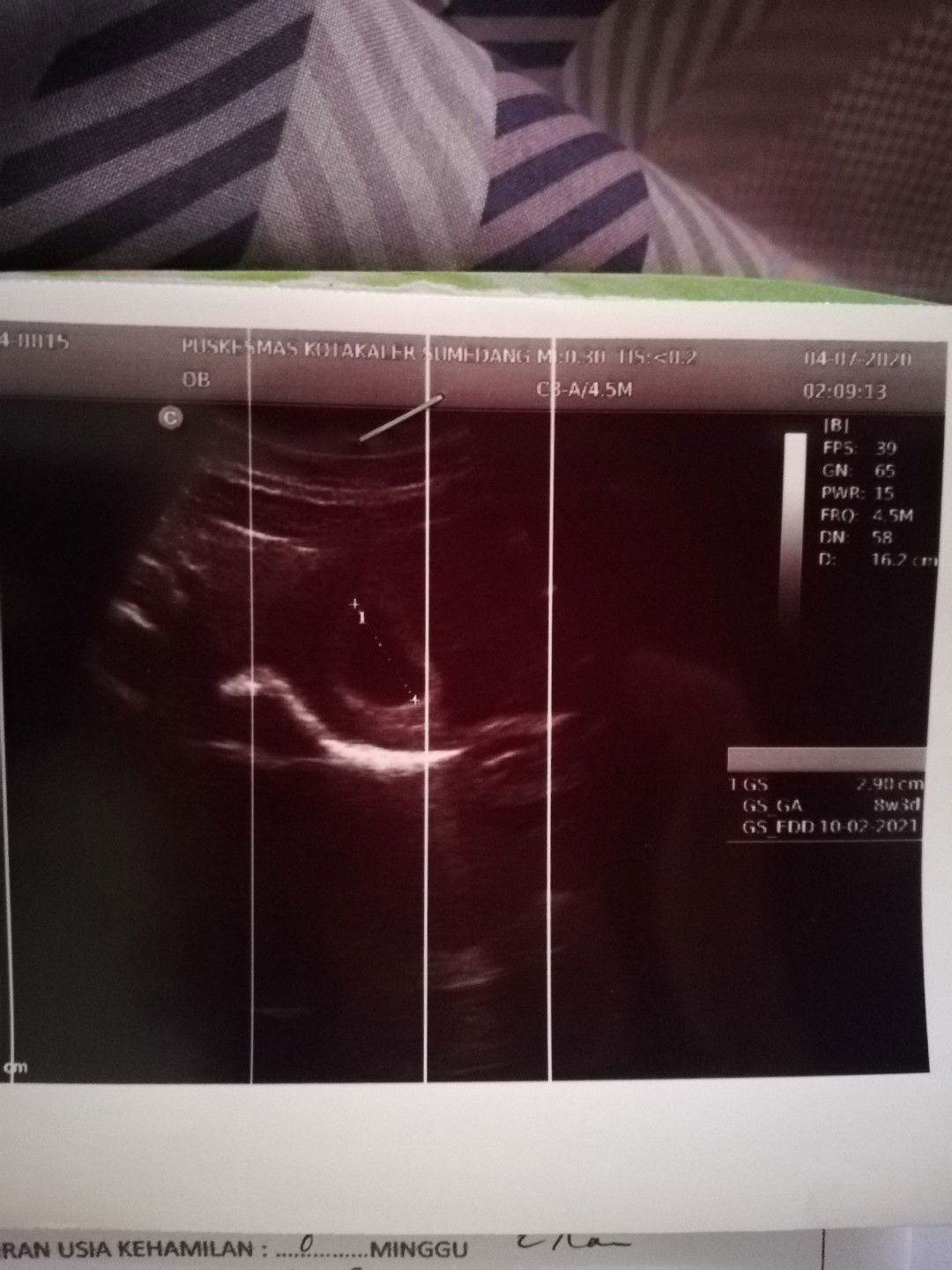 Usia kandungan 8week tapi masih terlihat Kantung Kehamilan