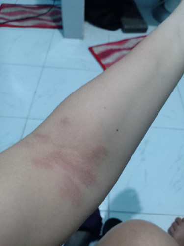 Skin rushes