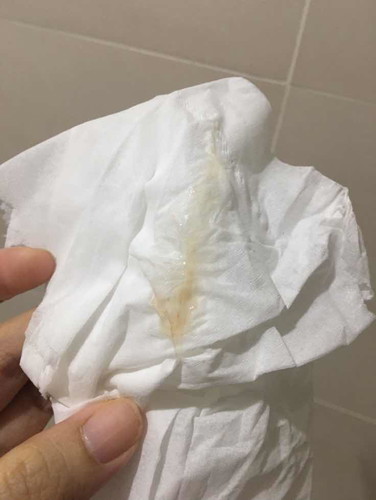 ทัองประมาน5สัปดาห์ ปวดหน่วงๆ มีตกขาวเมือกๆ มีสีน้ำตาลปนนิดหน่อย ไม่เยอะอ่านดูบาง ท่าน บอกมดลูก กะลังฝังตัว บางท่านบอกอาจมีภาว ะแท้ง อีก2อาทิตย คุณหมอนัด ควรไปพบก่อนเลยมั้ยคะ