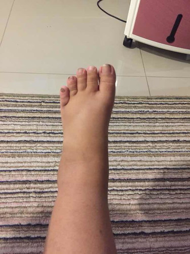 เท้าบวมมีวิธีแก้ยังไงได้บ้างค่ะ