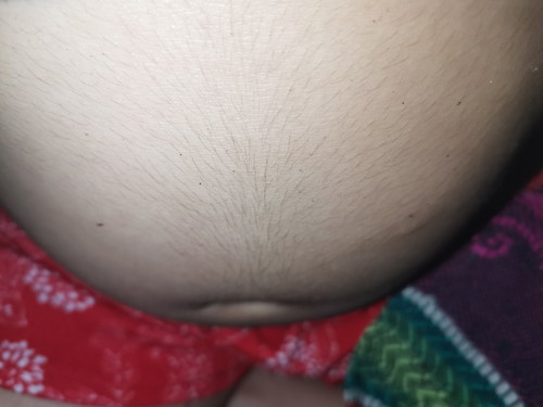 HAIRY BUMP