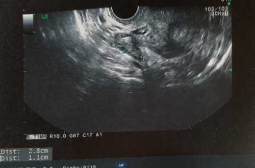 7week 1day นับจากประจำเกือนวันแรกครั้งล่าสุด หมอบอก 99% แท้งแล้ว
