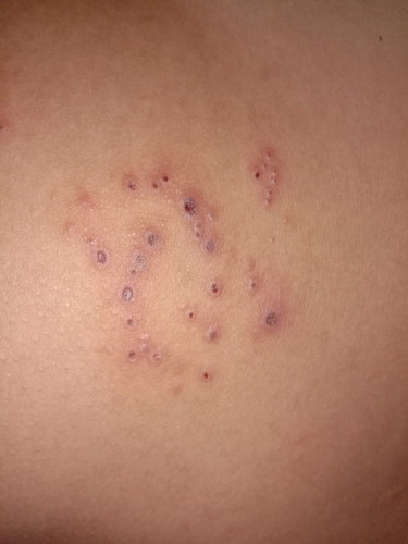 ผื่นขึ้นแบบนี้มีผลกับลูกน้อยไหมค่ะ