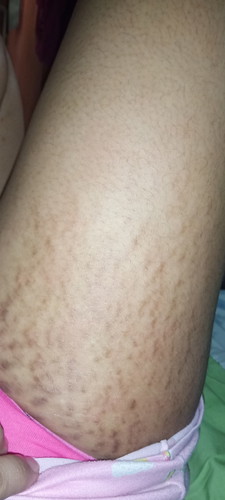 STRETCHMARK