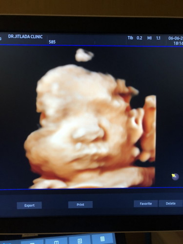 34w5d