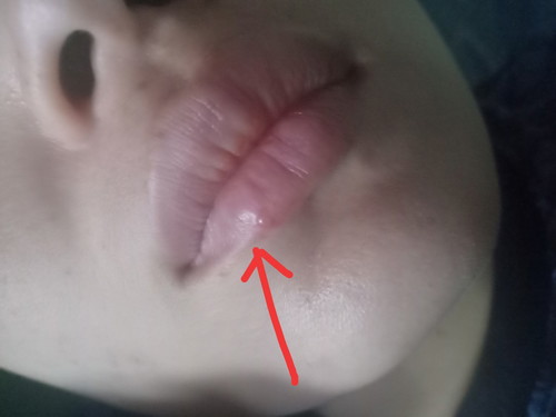 ตุ่มใส