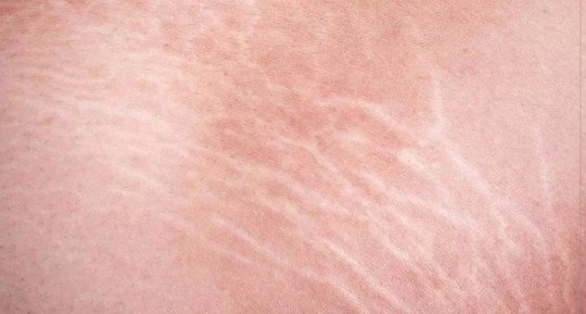 Stretch Marks