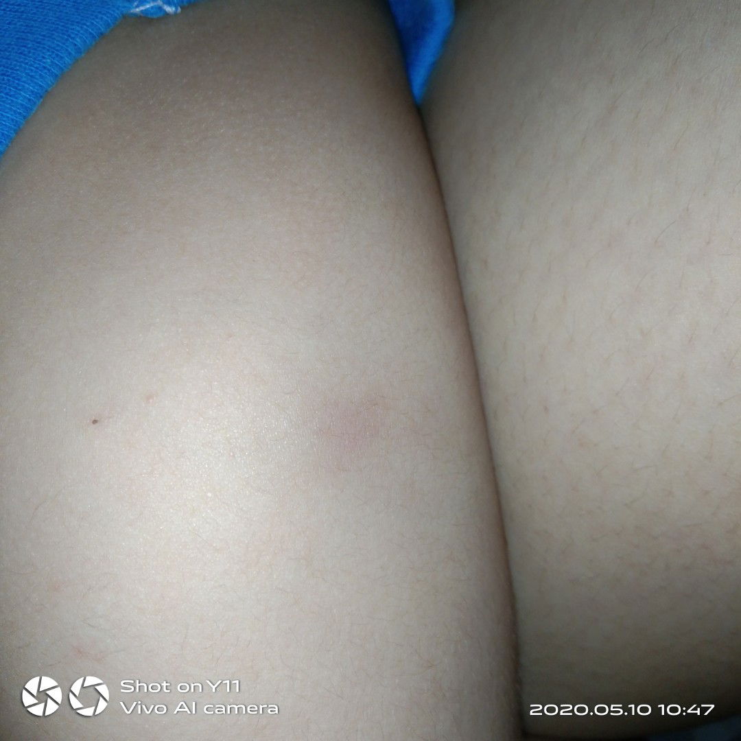 2nd bakuna 3months baby boy