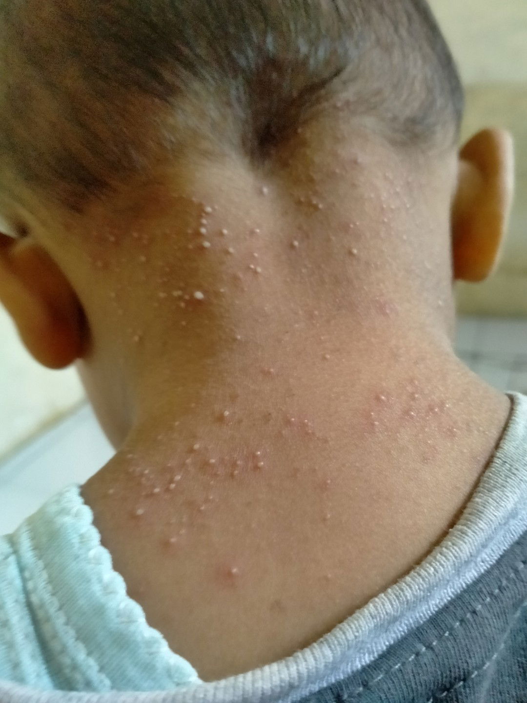 biang keringat atau bukan