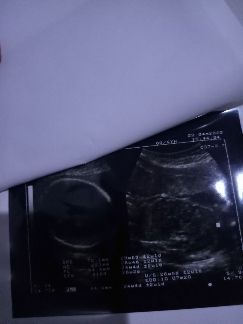 bisakah hasil usg jenis kelamin bayi berubah dalam waktu 4 minggu