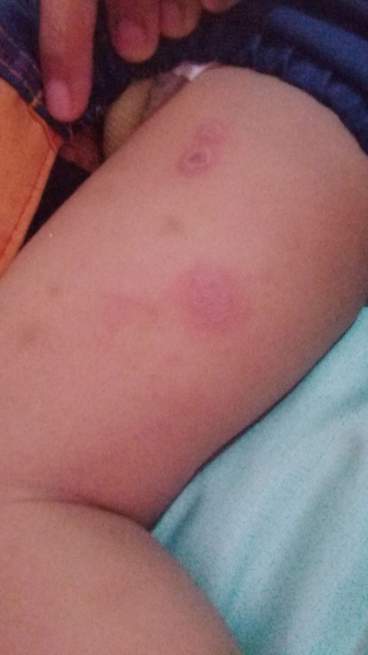 penyakit kulit/alergi