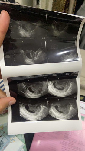 Missed miscarriage