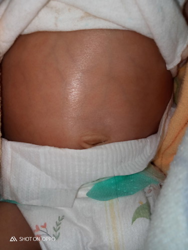 ลูกท้องป่อง