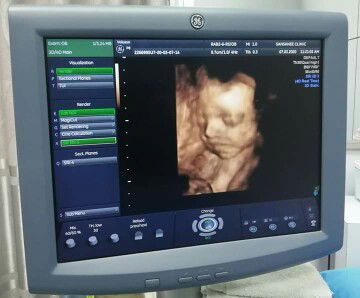 ตอนนี้ตั้งครรภ์ได้28วีค แต่แม่น้ำตาลเกิน แม่ๆท่านไหนมีัวิธีควบคุมน้ำตาลมั่งคะ