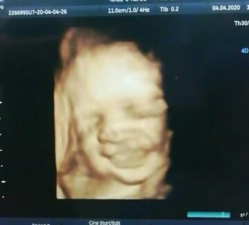 ภาพอัลตราซาวน์