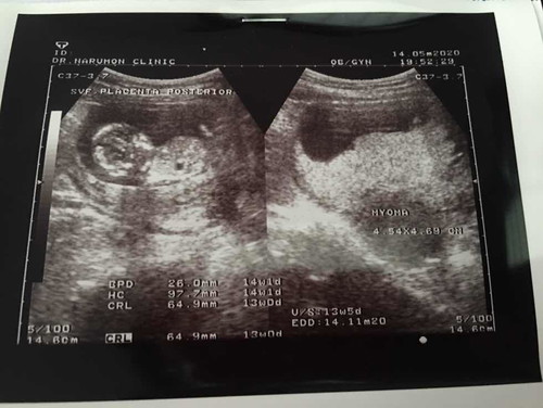 สวัสดีค่ะอยากสอบถามค่ะขนาดทารกในครรภ์14weekตอนนี้6เซนติเมตร