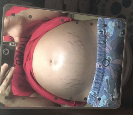 Stretchmarks