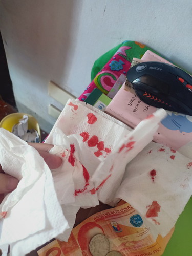 Nosebleed - normal ba ito sa buntis?