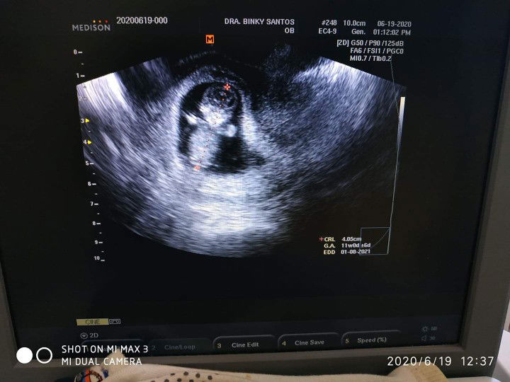 Ultrasound
