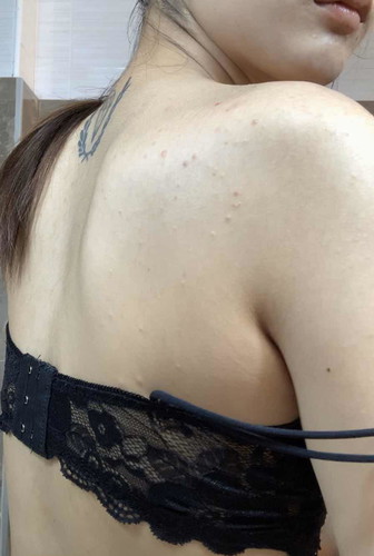 ท้อง 16 Week ผื่นแบบนี้ขึ้นเต็มหลัง