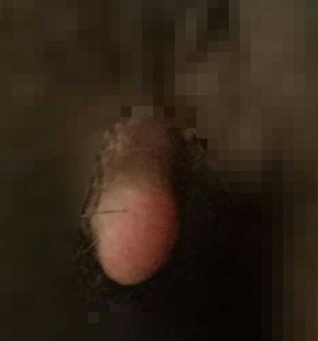 แผลฝีเย็บบวม