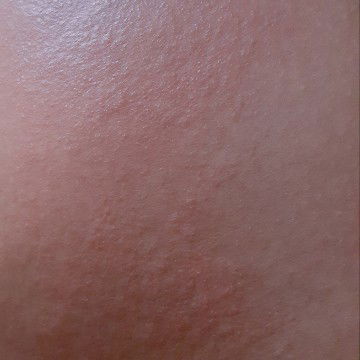 Gatal² di Area Perut