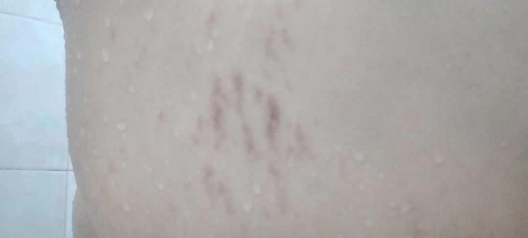 วิธีลบรอยแตกลายหลังคลอด