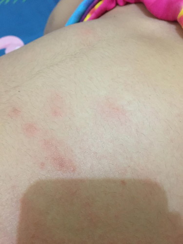 Gatal ruam pada perut apa berbahaaya ya bun? Salep atau obat gatal apa yang cocok untuk ibu hamil?