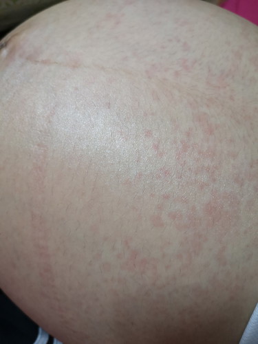 Red Dots Or Rashes On Pregnant Belly