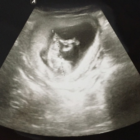 11 week