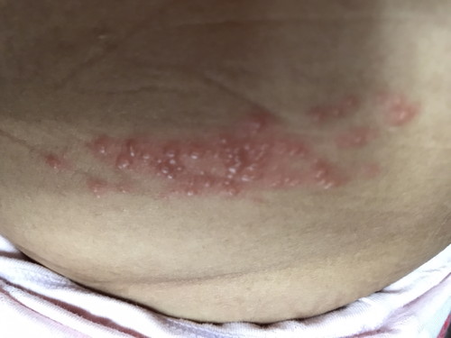 Apa ini herpes ?