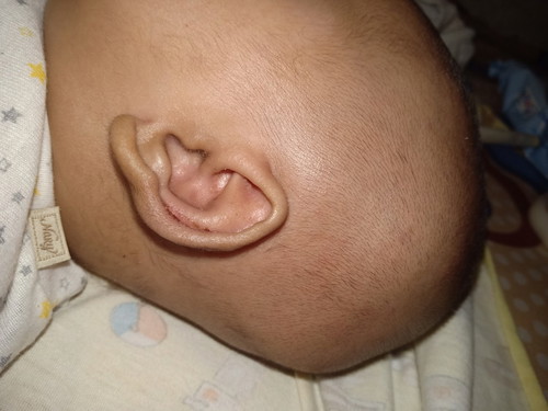 daun telinga anak benyek sampai bedarah