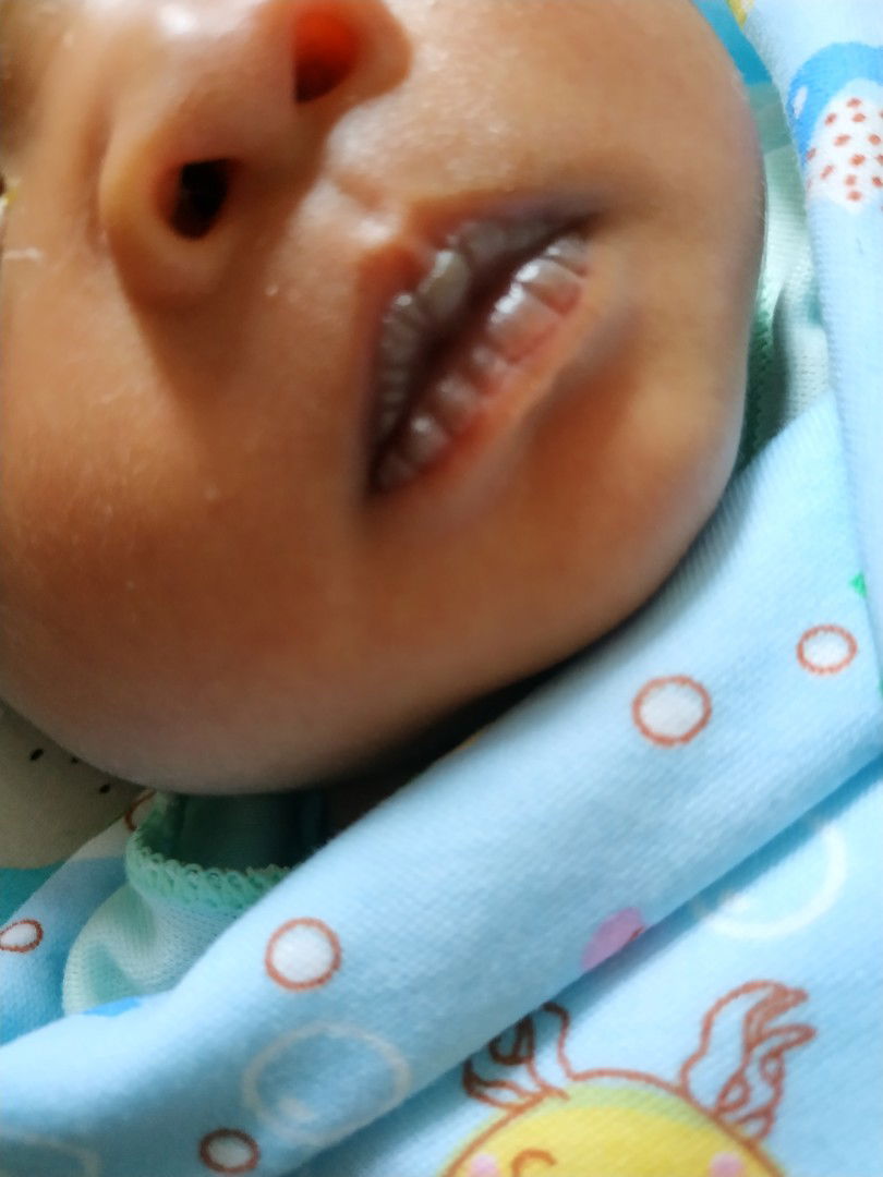 bibir hitam pada bayi