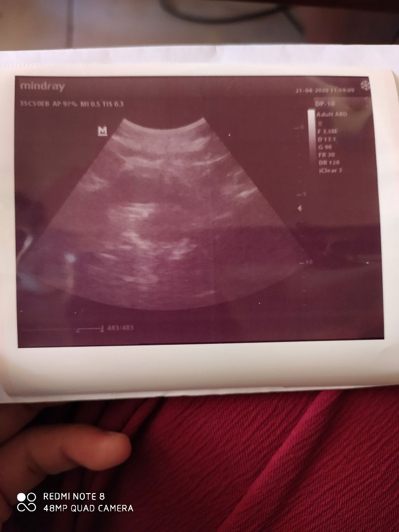 Bun ini hasil usgnya udah kelihatan kantong kehamilsnkah ?